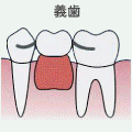 義歯の場合